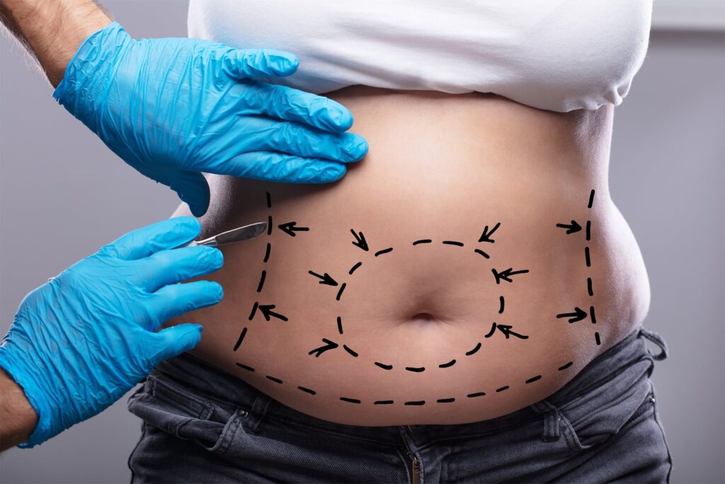 How Much Weight Can You Lose With Liposuction